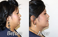 chin liposuction