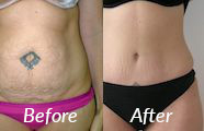 tummy tuck