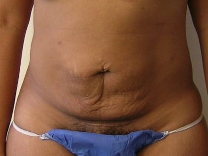 Tummy Tuck Before & After Patient #435