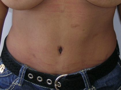 Tummy Tuck Before & After Patient #435