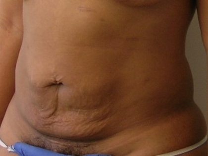 Tummy Tuck Before & After Patient #435