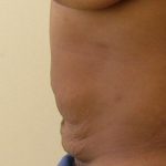 Tummy Tuck Before & After Patient #435