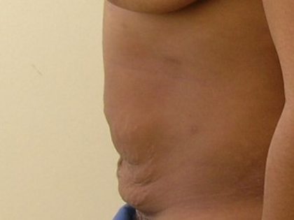 Tummy Tuck Before & After Patient #435