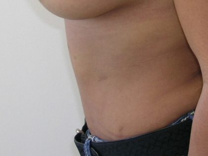 Tummy Tuck Before & After Patient #435