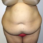 Tummy Tuck Before & After Patient #442