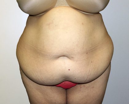Tummy Tuck Before & After Patient #442