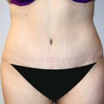 Tummy Tuck Before & After Patient #442