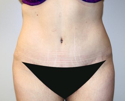 Tummy Tuck Before & After Patient #442