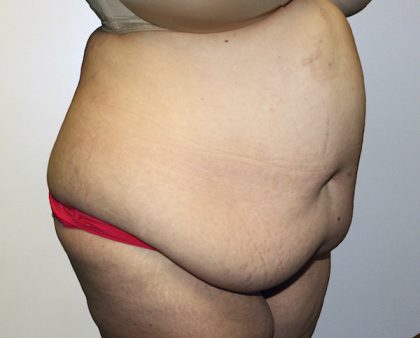 Tummy Tuck Before & After Patient #442