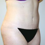 Tummy Tuck Before & After Patient #442