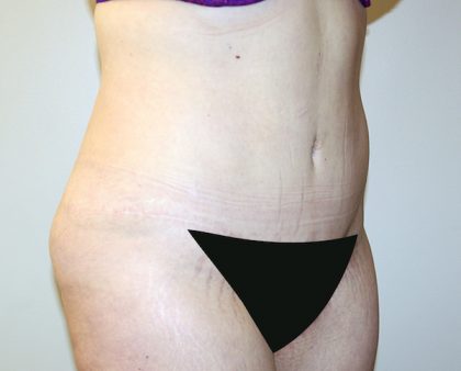 Tummy Tuck Before & After Patient #442