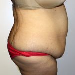 Tummy Tuck Before & After Patient #442