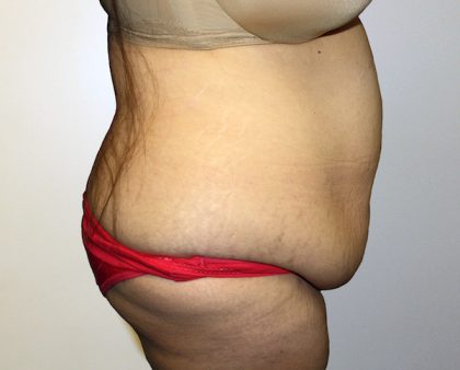 Tummy Tuck Before & After Patient #442