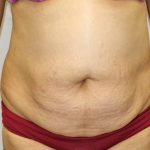 Tummy Tuck Before & After Patient #373