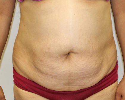 Tummy Tuck Before & After Patient #373
