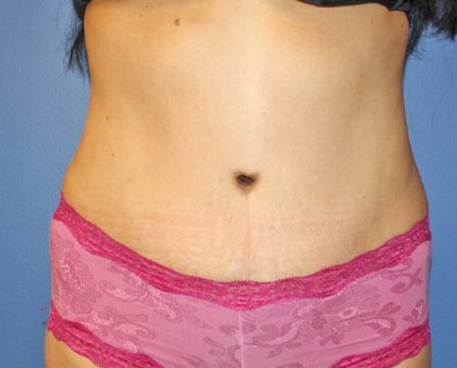 Tummy Tuck Before & After Patient #373