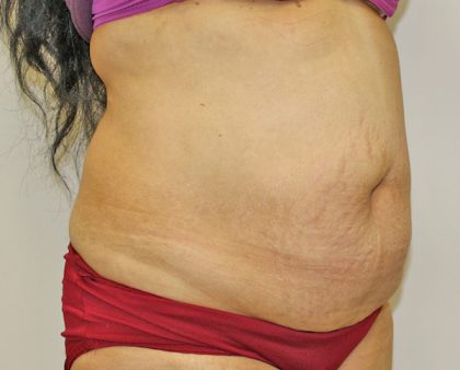 Tummy Tuck Before & After Patient #373