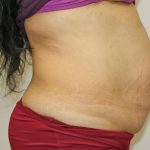 Tummy Tuck Before & After Patient #373