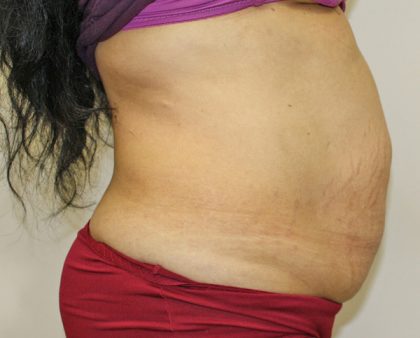 Tummy Tuck Before & After Patient #373