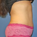 Tummy Tuck Before & After Patient #373