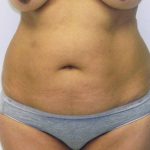 Tummy Tuck Before & After Patient #380