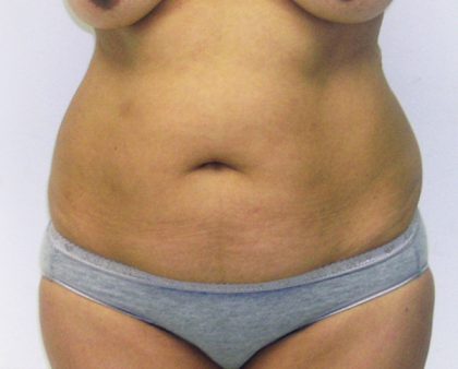 Tummy Tuck Before & After Patient #380