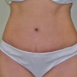 Tummy Tuck Before & After Patient #380