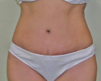 Tummy Tuck Before & After Patient #380