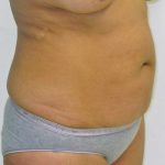 Tummy Tuck Before & After Patient #380