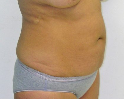 Tummy Tuck Before & After Patient #380