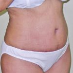 Tummy Tuck Before & After Patient #380