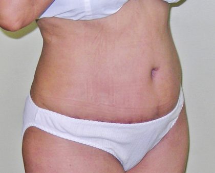 Tummy Tuck Before & After Patient #380