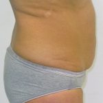 Tummy Tuck Before & After Patient #380