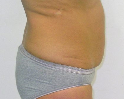 Tummy Tuck Before & After Patient #380