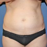 Tummy Tuck Before & After Patient #387