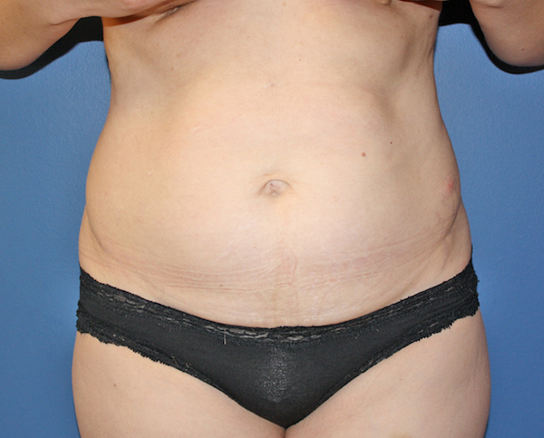 Tummy Tuck Before & After Patient #387