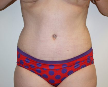 Tummy Tuck Before & After Patient #387