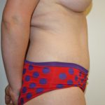 Tummy Tuck Before & After Patient #387