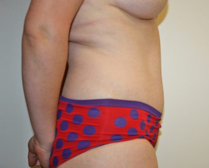 Tummy Tuck Before & After Patient #387