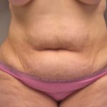 Tummy Tuck Before & After Patient #394