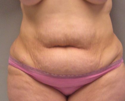 Tummy Tuck Before & After Patient #394