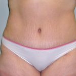 Tummy Tuck Before & After Patient #394