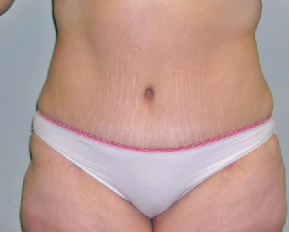 Tummy Tuck Before & After Patient #394