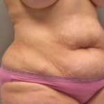 Tummy Tuck Before & After Patient #394