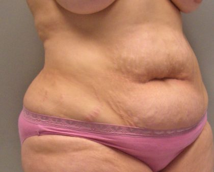 Tummy Tuck Before & After Patient #394