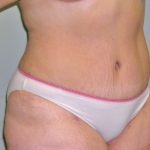 Tummy Tuck Before & After Patient #394