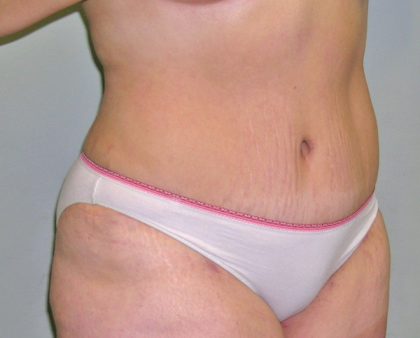 Tummy Tuck Before & After Patient #394