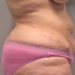 Tummy Tuck Before & After Patient #394