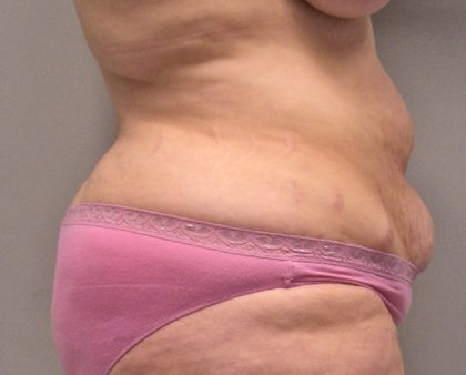 Tummy Tuck Before & After Patient #394