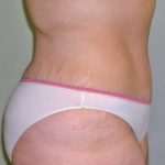 Tummy Tuck Before & After Patient #394